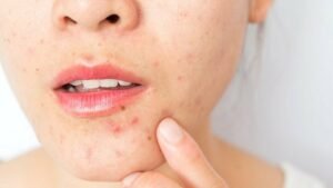 What Causes Acne Scars And How To Prevent It